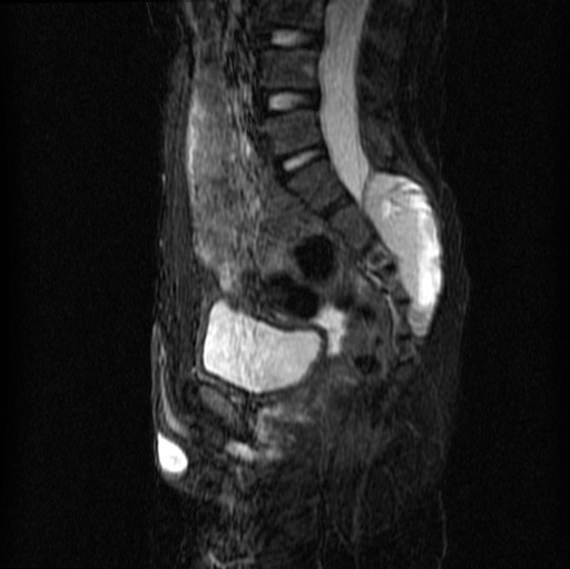 File:Aneurysmal bone cyst - sacrum (Radiopaedia 65190-74196 Sagittal STIR 18).jpg