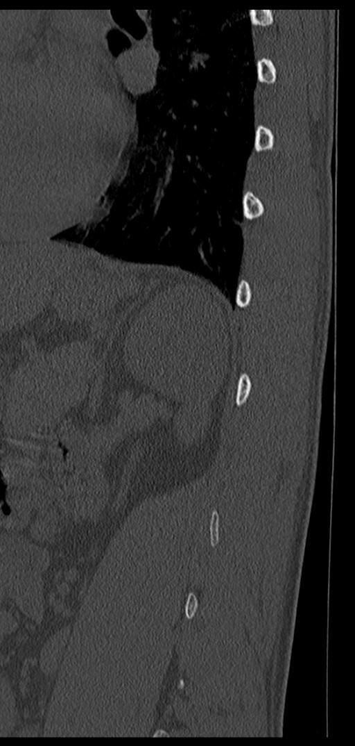 Aneurysmal bone cyst T11 (Radiopaedia 29294-29721 Sagittal bone window 12).jpg