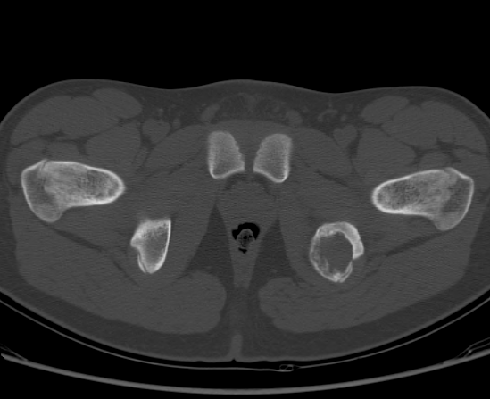 File:Aneurysmal bone cyst of ischium (Radiopaedia 25957-26094 Axial bone window 68).png