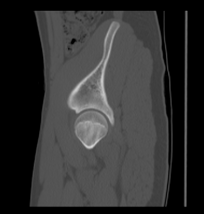 Aneurysmal bone cyst of ischium (Radiopaedia 25957-26094 Sagittal bone window 17).png
