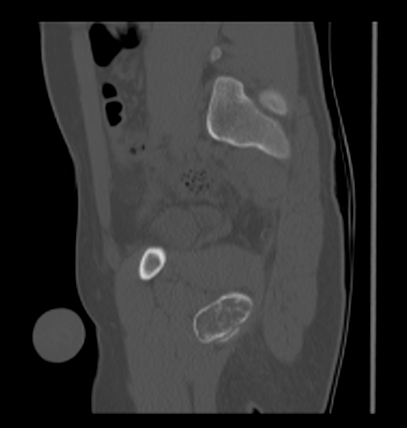 Aneurysmal bone cyst of ischium (Radiopaedia 25957-26094 Sagittal bone window 47).png