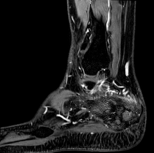 File:Aneurysmal bone cyst of the calcaneus (Radiopaedia 60669-68420 F 4).jpg