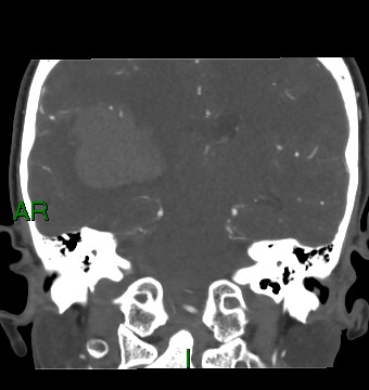 Aneurysmal subarachnoid hemorrhage with intra-axial extension (Radiopaedia 84371-99732 C 45).jpg