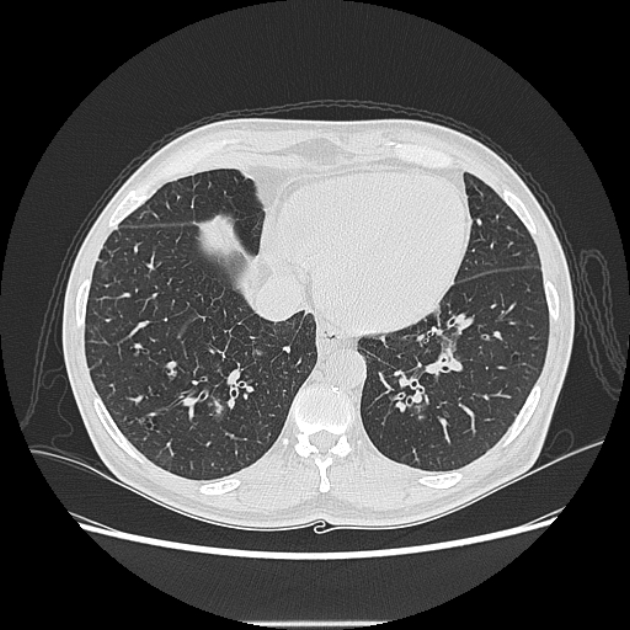 Angioinvasive aspergellosis (Radiopaedia 66995-76315 Axial lung window 38).jpg