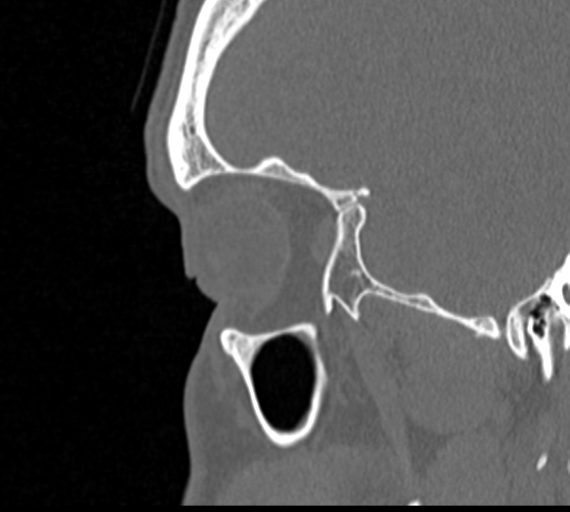 Angular epidermoid cyst (Radiopaedia 46908-51439 Sagittal bone window 10).png