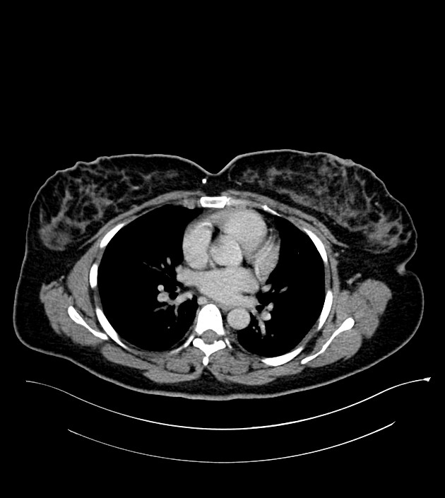 Anterior abdominal wall CSF pseudocyst (CSFoma) (Radiopaedia 79453-92571 A 1).jpg