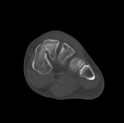 Anterior calcaneal process fracture (Radiopaedia 47384-51989 Coronal bone window 42).png