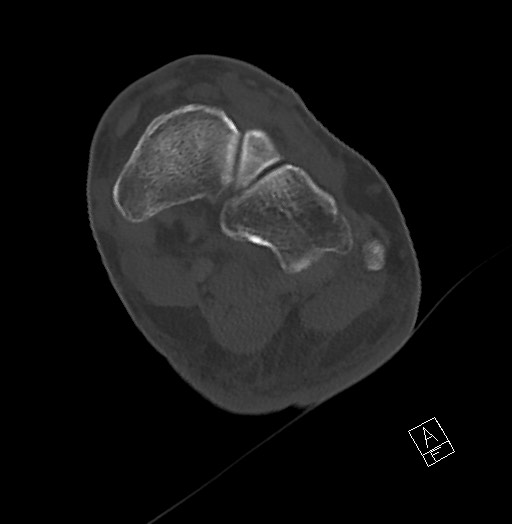 File:Anterior calcaneal process fracture (Radiopaedia 63353-71943 Axial bone window 85).jpg