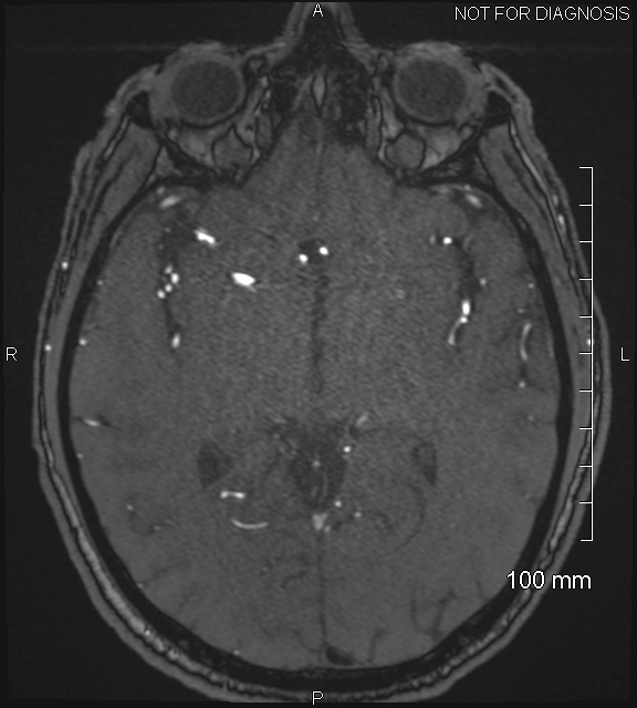 Anterior cerebral artery aneurysm (Radiopaedia 80683-94127 Axial MRA 113).jpg