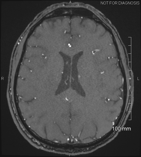 Anterior cerebral artery aneurysm (Radiopaedia 80683-94127 Axial MRA 155).jpg