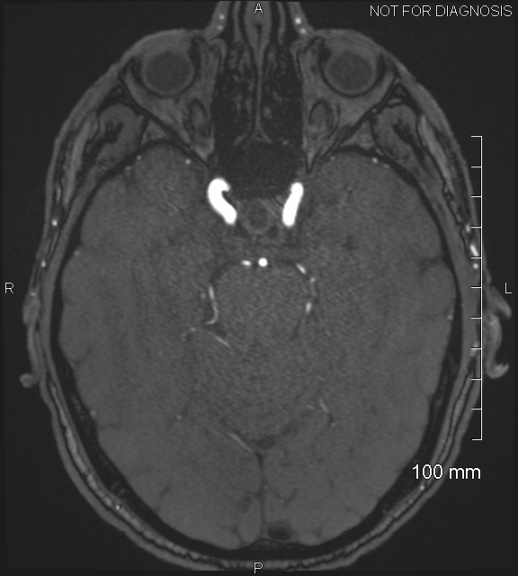 Anterior cerebral artery aneurysm (Radiopaedia 80683-94127 Axial MRA 83).jpg