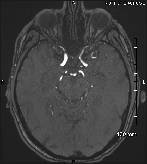 Anterior cerebral artery aneurysm (Radiopaedia 80683-94127 Axial MRA 93).jpg
