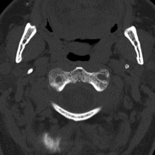 Anterior cervical postdiscectomy arthrodesis (Radiopaedia 32678-33646 Axial bone window 17).jpg