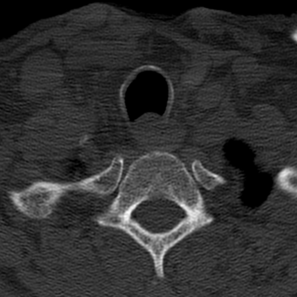 Anterior cervical postdiscectomy arthrodesis (Radiopaedia 32678-33646 Axial bone window 67).jpg