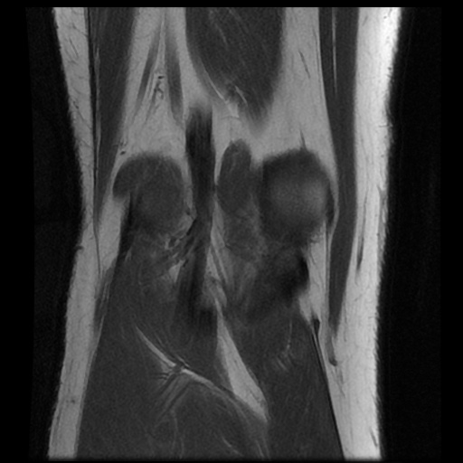 File:Anterior cruciate ligament avulsion fracture (Radiopaedia 58939-66193 Coronal T1 16).jpg