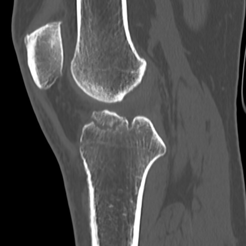 File:Anterior cruciate ligament avulsion fracture (Radiopaedia 58939-66194 Sagittal bone window 20).jpg