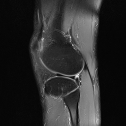 File:Anterior cruciate ligament full thickness tear (Radiopaedia 66268-75467 Sagittal PD fat sat 19).jpg