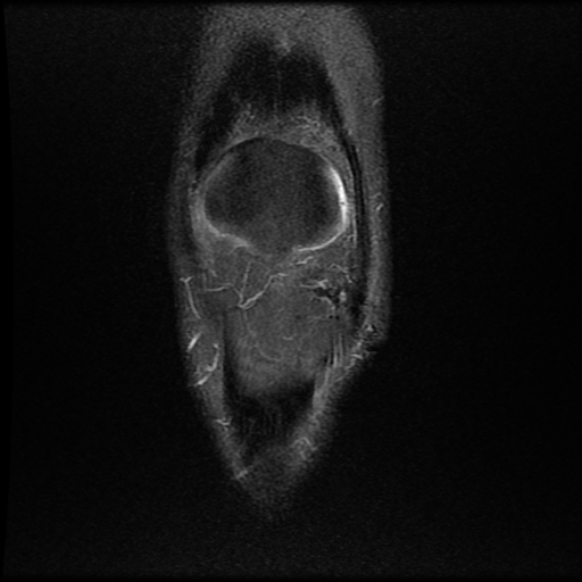 File:Anterior cruciate ligament graft tear and bucket-handle tear of medial meniscus (Radiopaedia 75867-87254 Coronal PD fat sat 4).jpg