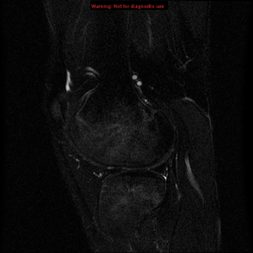 File:Anterior cruciate ligament injury - partial thickness tear (Radiopaedia 12176-12515 Sagittal T2 fat sat 14).jpg