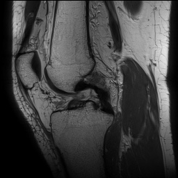 Anterior cruciate ligament rupture with Segond fracture (Radiopaedia 69043-78806 Sagittal PD 91).jpg