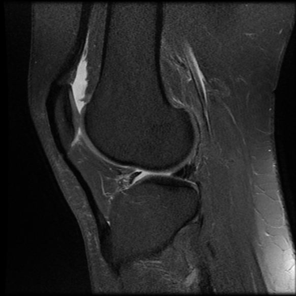 File:Anterior cruciate ligament tear, Wrisberg rip and bucket-handle tear of medial meniscus (Radiopaedia 75872-87266 Sagittal PD fat sat 9).jpg