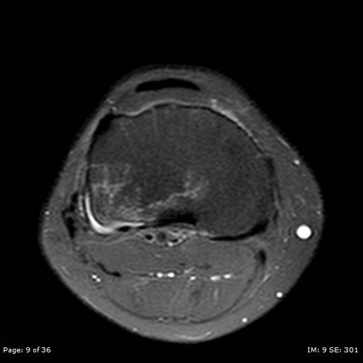 File:Anterior cruciate ligament tear (Radiopaedia 70783-80964 Axial PD fat sat 9).jpg