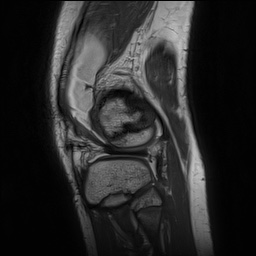 File:Anterior cruciate ligament tear - pediatric (Radiopaedia 62152-70260 Sagittal PD 143).jpg