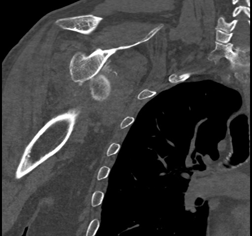 Anterior glenohumeral dislocation with Hill-Sachs lesion (Radiopaedia 62877-71249 Coronal bone window 61).jpg
