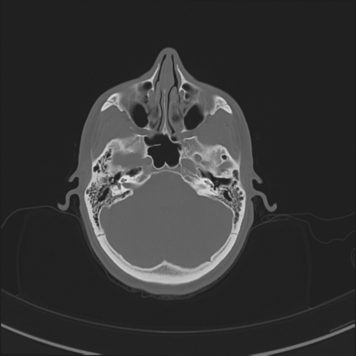 Anterior nasal spine fracture (Radiopaedia 46138-50494 Sagittal bone window 1).png