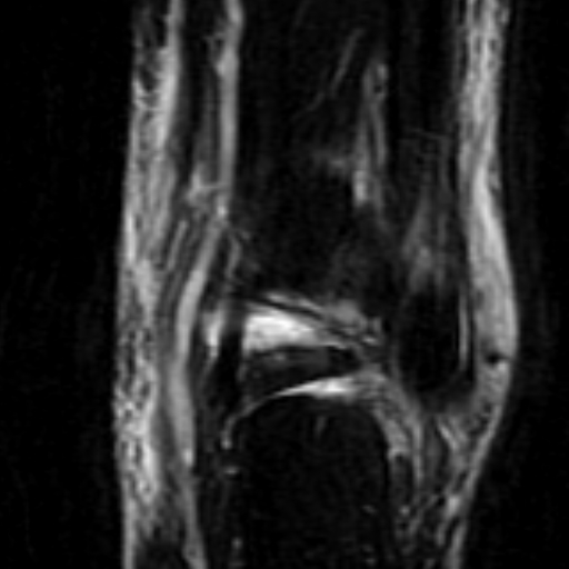File:Anterior talofibular ligament rupture (Radiopaedia 15831-15484 Coronal STIR 17).jpg