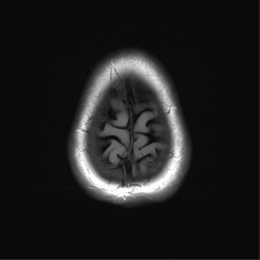 File:Anterior temporal pole cysts (Radiopaedia 46629-51102 Axial FLAIR 26).png