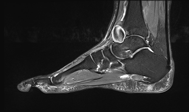 File:Anterior tibial artery false aneurysm (Radiopaedia 88984-105808 Sagittal STIR 14).jpg