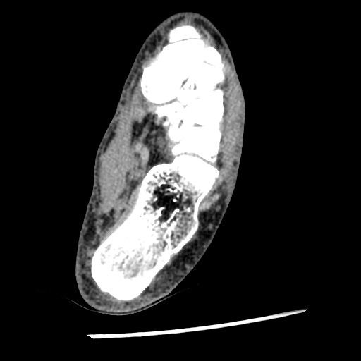Anterior tibial artery false aneurysm (Radiopaedia 88984-105809 A 188).jpg