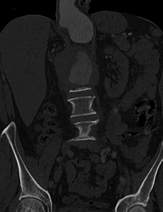 File:Anterior vertebral scalloping (abdominal aortic aneurysm) (Radiopaedia 66744-76067 Coronal bone window 24).jpg