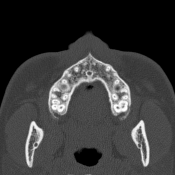 Antrochoanal polyp (Radiopaedia 33984-35202 Axial bone window 2).jpg