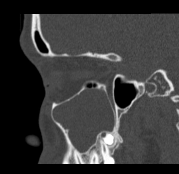 Antrochoanal polyp (Radiopaedia 33984-35202 Sagittal bone window 24).jpg