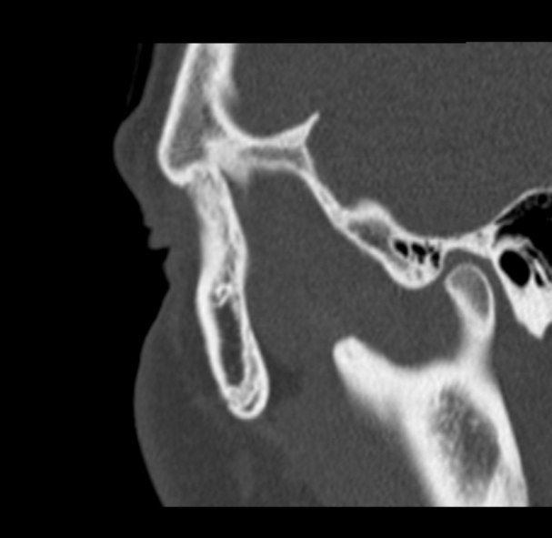 File:Antrochoanal polyp (Radiopaedia 33984-35202 Sagittal bone window 82).jpg