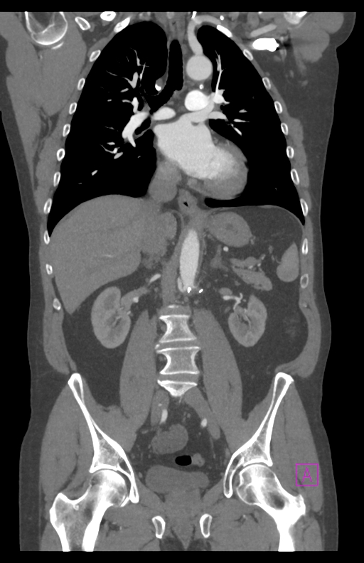 Aortectomy and axillary-bifemoral bypass (Radiopaedia 28303-28545 C 51).jpg