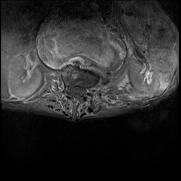 File:Aortic aneurysm with spinal destruction (Radiopaedia 42301-45409 Axial T1 fat sat 9).jpg