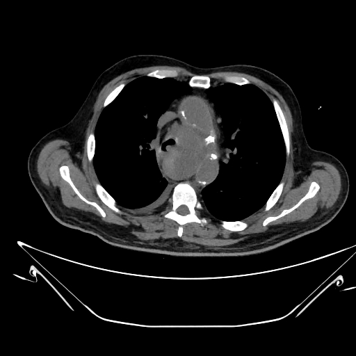 Aortic arch aneurysm (Radiopaedia 84109-99365 Axial non-contrast 106).jpg