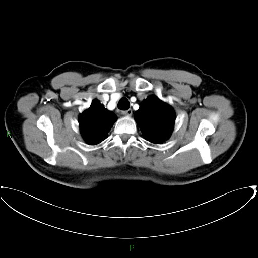Aortic arch origin of left vertebral artery (Radiopaedia 46327-50737 Axial post contrast 18).jpg