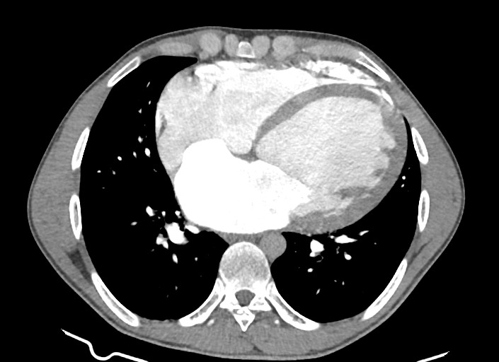 File:Aortic coarctation with aneurysm (Radiopaedia 74818-85828 A 88).jpg
