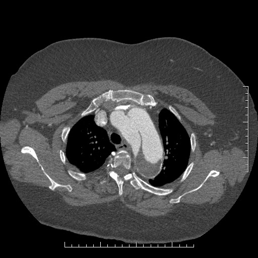 Aortic dissection- Stanford A (Radiopaedia 35729-37268 A 15).jpg