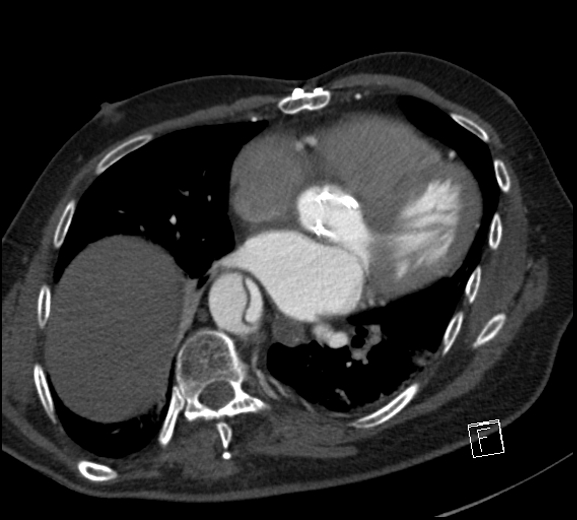 File:Aortic dissection (CTPA) (Radiopaedia 75506-86750 A 58).jpg