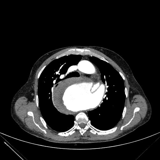 Aortic dissection (Radiopaedia 27466-27665 C+ arterial phase 79).jpg