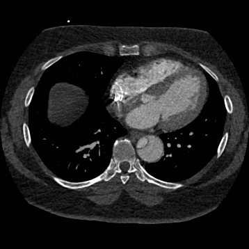 Aortic dissection (Radiopaedia 57969-64959 A 199).jpg