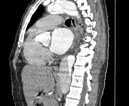 Aortic dissection - Stanford A -DeBakey I (Radiopaedia 28339-28587 C 35).jpg