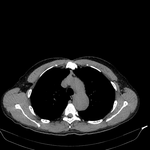 Aortic dissection - Stanford type A (Radiopaedia 83418-98500 Axial non-contrast 12).jpg