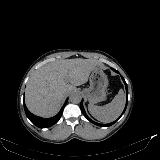 File:Aortic dissection - Stanford type A (Radiopaedia 83418-98500 Axial non-contrast 41).jpg