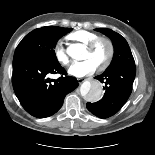 File:Aortic dissection - Stanford type B (Radiopaedia 50171-55512 A 31).png